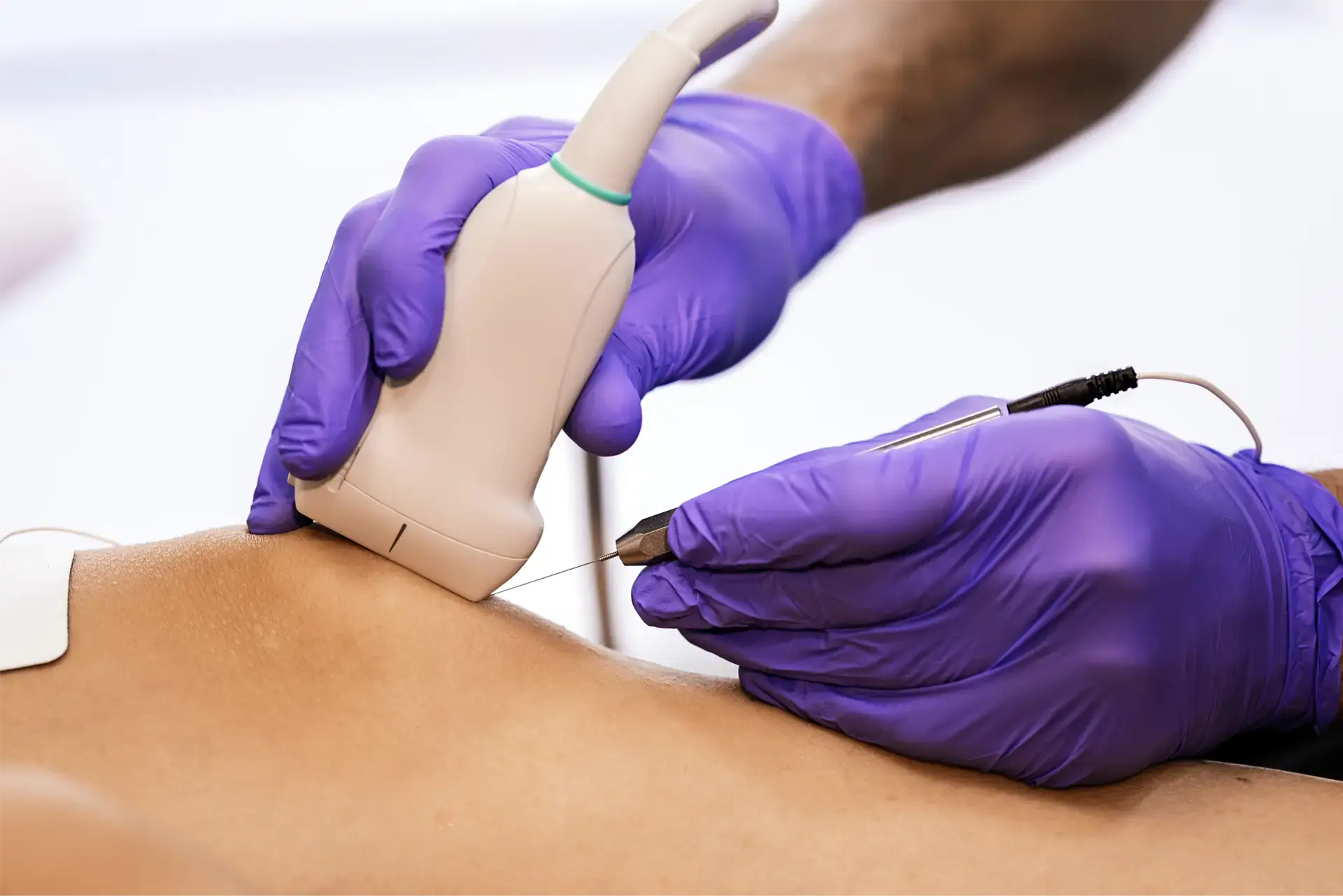 Edirne İğneli Epilasyon