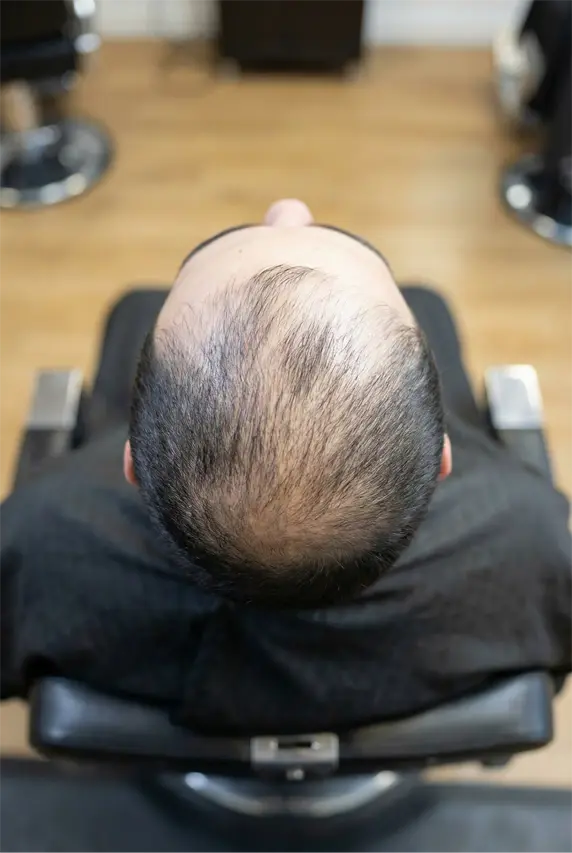 Edirne Saç Güçlendirme