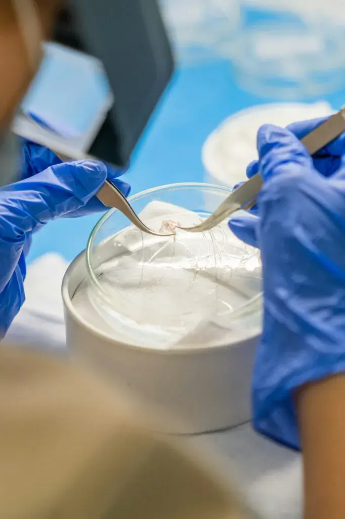 Surgeon performing the classification of follicular units with forceps for hair transplantation.